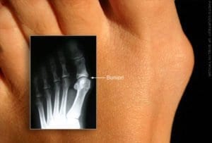 Picture of a bunion with an x-ray of the bunion