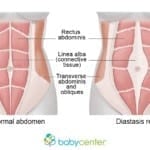 diastasis rectus abdominis