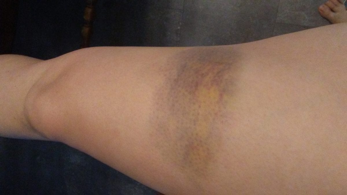 my bruise on my thigh